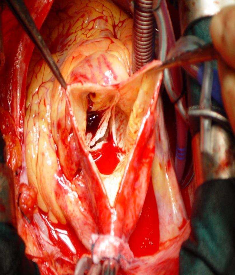 Zone 0 proximal anastomosis If you can spare the root,