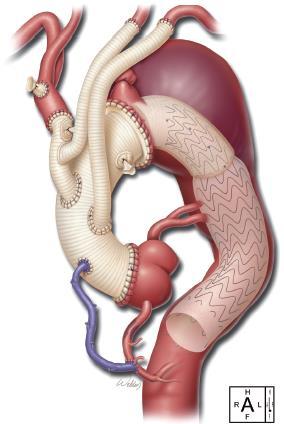 ) FET combines conventional surgical replacement of the ascending aorta and the aortic arch with endovascular repair of the descending aorta.