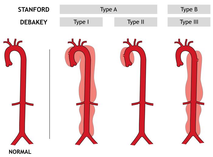 Classification Image source: Thoracic Aortic Dissection Author: Matthew P.