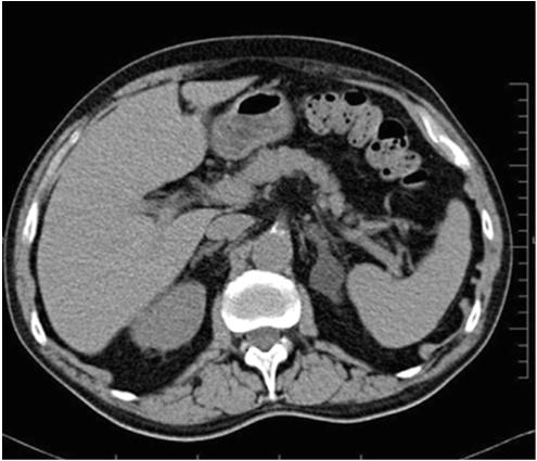 Pheochromocytoma Once confirmed treat with alpha blockade, eventually beta blockade and adrenalectomy with experienced surgeon and anesthesiologist Nodules 10% prevalence in autopsy