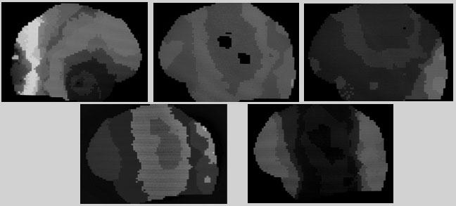 CET (Computer EEG Tomographic) scans of the Genain Sisters (Normal) PET Scans of People with