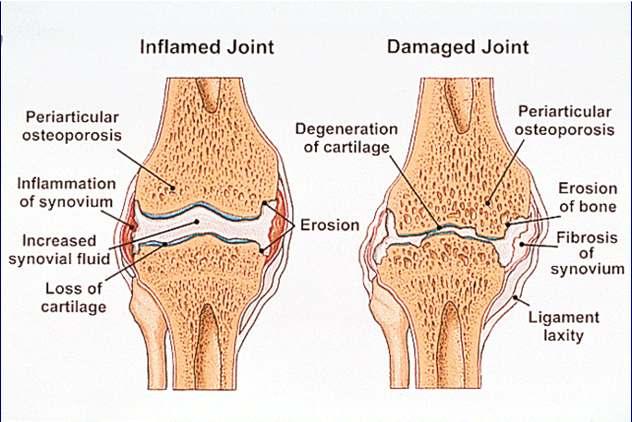 As inflammation progresses, the synovial lining grows over the cartilage and starts to erode it.