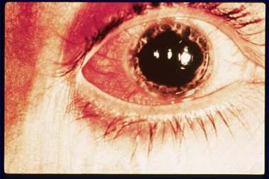 Intraocular inflammation affects iris and ciliary body Usually insidious and may be asymptomatic Activity of eye does not parallel