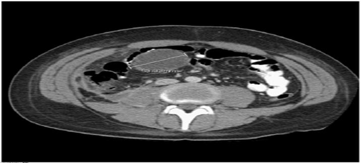 Post operative Appendectomy CT Scan ~ 35% 55 Post operative IR Drainage of Intraabdominal Abscess US guided drain placement Anaerobic and aerobic cultures obtained E. coli Bacteroides Klebsiella C.