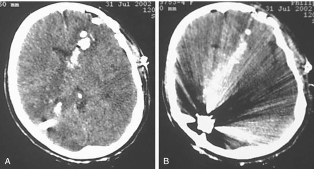 Head 3 times more likely to die GCS < 8, unilateral dilated pupil, transventricular or