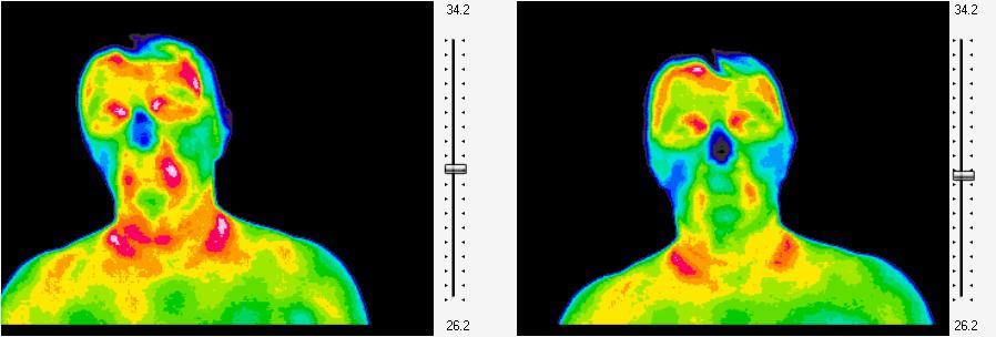 2. Case studies: Here we give five cases to illustrate the application of infrared imaging system in diagnostic and in evaluating quantitatively the effect of treatment with stable water clusters
