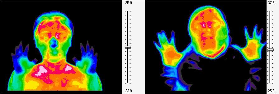 Fig 5 Thermal images of 26 year old woman. The left image of the face and hands was taken in August 2010 before healing with SWC.