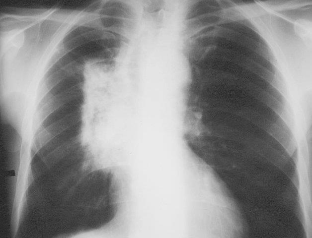 Lung/Upper GI Pneumonitis Dyspnoea, cough, fever 1-6 months post RT Corticosteroids O2 if severe Oesophagitis Sharp, burning