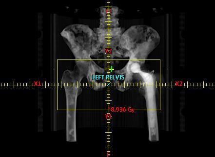Bone Acute pain flare after large fraction (palliative) RT for bone metastases