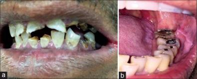 Dental Caries Rare < 30 Gy, 2-3x increased 30 60 Gy, 10x increased risk > 60 Gy Retraction of gingiva, circumferential decay Demineralization, generalized erosions, worn occlusal surfaces