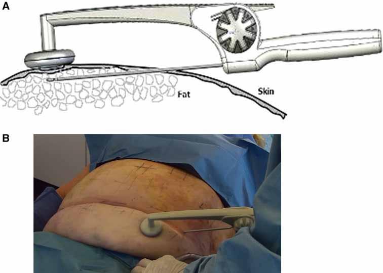 Fig. 1 BodyLite handpiece applied to the skin.a The internal electrode also is a hollow, blunt-nosed Mercedes configuration cannula.
