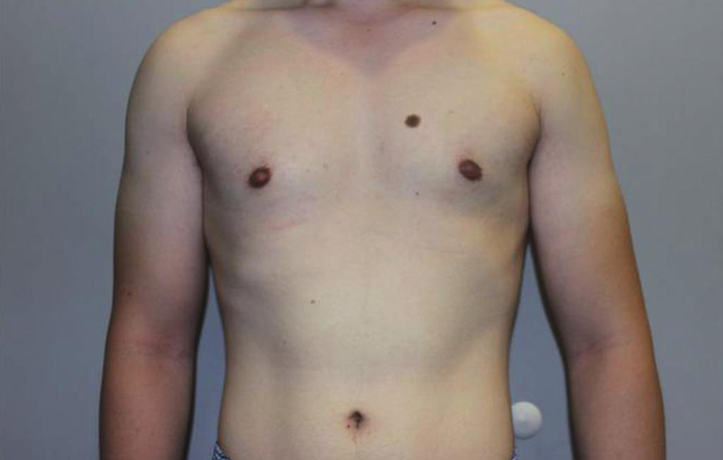 The surrounding subcutaneous fat the chest bordering the breast is feathered by suction to avoid noticeable saucers deformity.