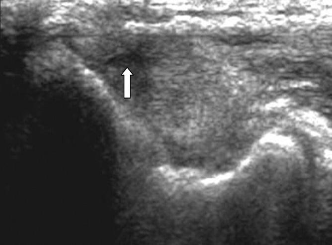 740 ULTRASONOGRAPHY OF MEDIAL EPICONDYLITIS, Park Fig 2. A longitudinal ultrasonographic image of the common flexor tendon of the left elbow in a 49-year-old man with medial epicondylitis.