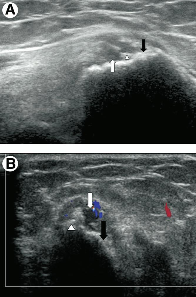 Abnormal Ultrasonographic Findings Abnormal ultrasonographic findings were detected in 20 elbows with medial epicondylitis.
