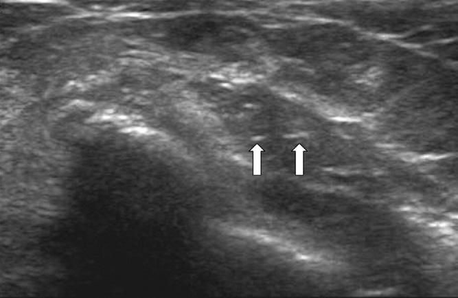 ULTRASONOGRAPHY OF MEDIAL EPICONDYLITIS, Park 741 Fig 4. A transverse grayscale image of the common flexor tendon of the left elbow in a 53-year-old woman with medial epicondylitis.