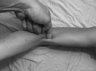 forearm supination DISTAL BICEPS RUPTURE Diagnosis: