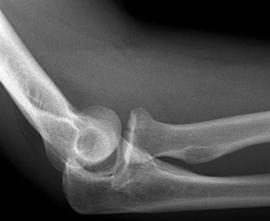 outstretched hand Treatment is based on displacement of fracture <2mm displacement - non-op >2mm displacement - ORIF comminuted - radial head replacement RADIAL HEAD FRACTURE Minimally