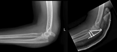 OLECRANON FRACTURE Can be due to a direct or indirect trauma Non-displaced fracture can be treated closed (long arm cast for 6 weeks) Displaced fracture - surgery to