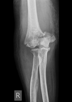 require operative reduction and stabilization Motion of 30-130 is considered a good result; occurs 75% of time Severe fractures in the elderly treated with elbow