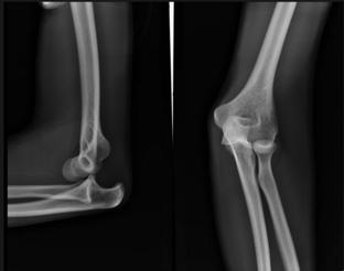 complex (associated fractures) Common large joint dislocation (2nd behind shoulder) Occurs in younger patients (teens - 30) Usually due to axial loading combined with