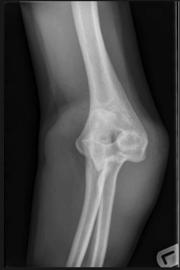 dislocation or subluxation can cause recurrent instability PLRI Elbow unstable in extension/ supination