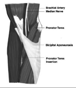 similar to CTS except medial elbow/forearm pain, palmar paresthesias (palmar cut.