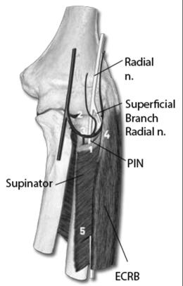 flexion splinting; surgical decompression unusual RADIAL TUNNEL SYNDROME Compression of the PIN in the radial tunnel