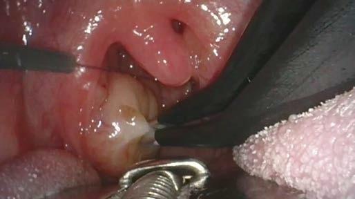PARTIAL REMOVAL OF HYPERTROPHIC TONSILS 04 Postoperative Care Because of the risk of swelling, it is recommended to keep children under postoperative observation for at least a couple of hours after