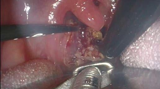 Make sure to use the tip of the electrode to cut into the depth of the tonsil