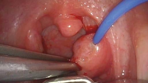 VOLUME REDUCTION OF HYPERTROPHIC TONSILS In the following chapter, it is demonstrated how to use bipolar radiofrequency-induced thermotherapy (RFITT) to reduce the volume of hypertrophic tonsils in