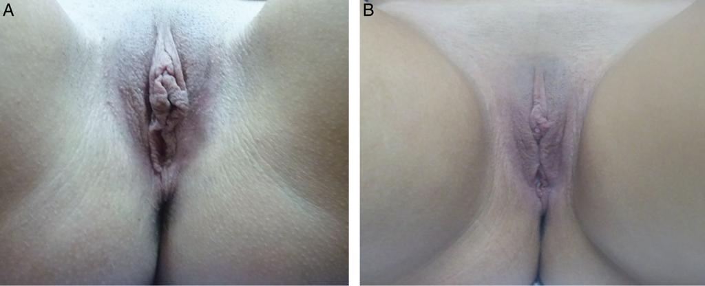 168 Aesthetic Surgery Journal 35(2) Figure 2. (A) This 19-year-old woman presented with hypertrophy of the labia minora and clitoral hood.