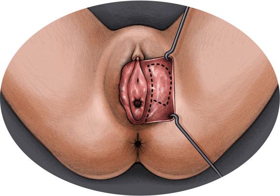 Bidimensional reduction of the labia minora, with full-thickness inferior wedge resection. Figure 12. Longitudinal resection of excess tissue at the clitoral hood, and reapproximation of the edges.