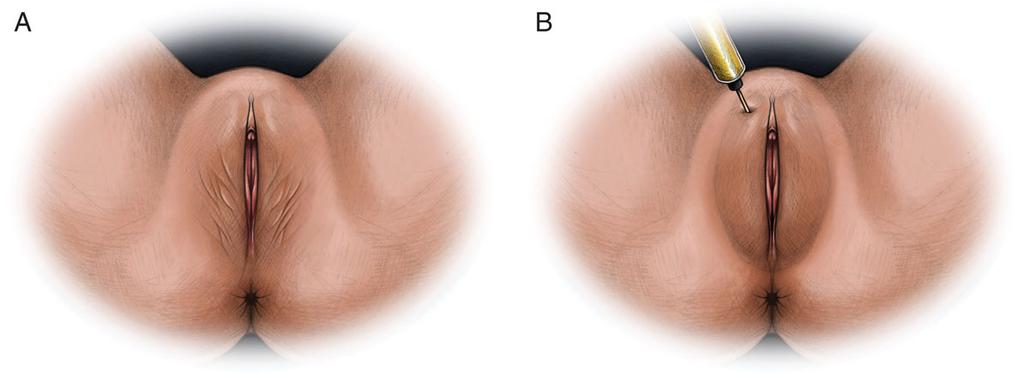 172 Aesthetic Surgery Journal 35(2) Figure 14. (A) Atrophy of the labia majora. (B) Fat injection to improve labial contour. Figure 15.