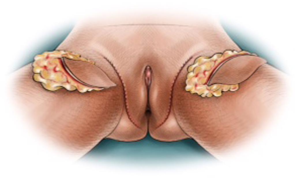 most commonly performed to decrease the size of the mons pubis. The surgeon should utilize 3-mm cannulae and proceed conservatively to avoid contour irregularities.