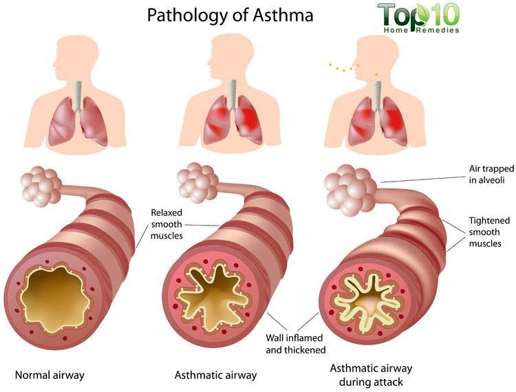 ASTHMA Allergies can trigger asthma.
