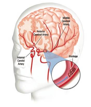 Your Guide to Ischemic What happened to me? You had a stroke. The stroke you had was most likely an ischemic (is-keem-ik) stroke, the most common type of stroke. Ischemic stroke.