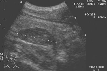 Easy on patient No radiation Parathyroid Ultrasound