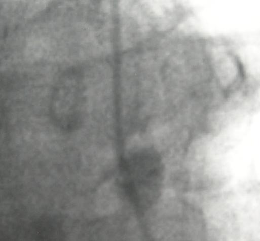 Post angiography