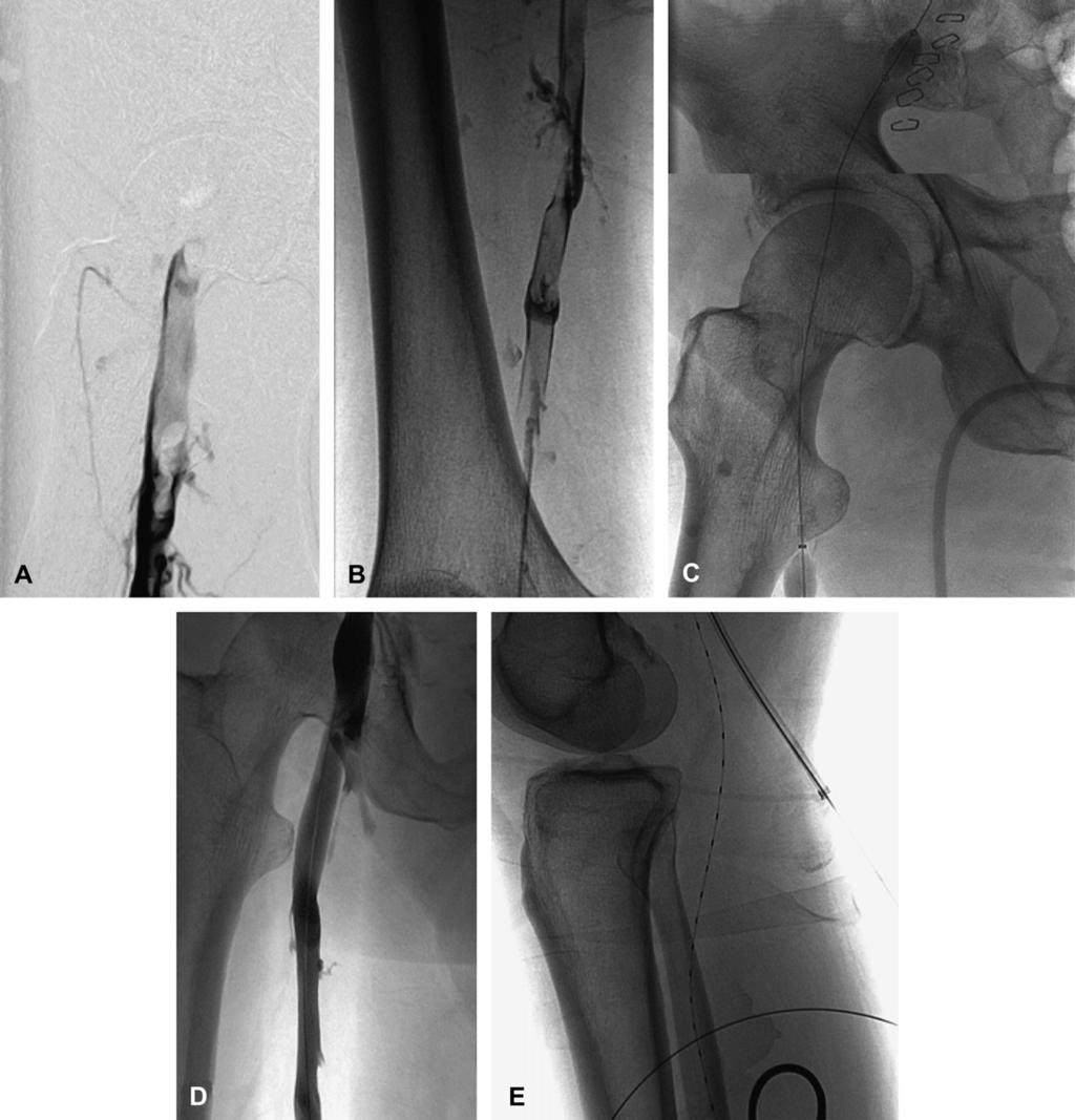 356 A. J. Comerota and D. Paolini Fig. 2. (A, B) Ascending phlebogram of a patient presenting with phlegmasia cerulea dolens of his left leg.