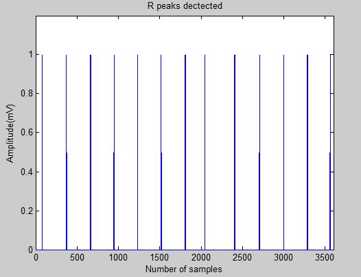 In QRS detection peak tracing and feature extraction is important process. It is used to detect abnormalities in the signals. Figure 12 shows peak tracing and feature extraction for ECG record 100.