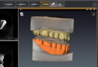 2 Capturing of the optical surface scan data of the patient s maxilla and mandible and