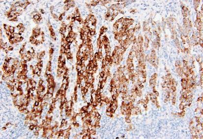 VENTANA ALK (D5F3) CDx Assay 790-4796 06687199001 50 Figure 1. VENTANA ALK (D5F3) CDx Assay staining in non-small cell lung carcinoma.