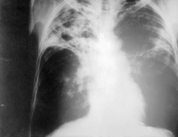 Suspect #3 Tuberculosis Mycobacterium tuberculosis Lungs infected by Tuberculosis Background: Tuberculosis is a disease caused by bacilli-shaped bacteria called Mycobacterium tuberculosis.