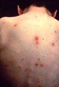 Chickenpox Suspect #6 Varicella-zoster virus Background: Chickenpox is disease caused by infection with the Varicella-zoster virus.