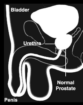 The prostate surrounds the urethra, which is the tube that carries urine from the bladder out of the body.