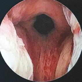 WHAT TO EXPECT DURING THE PROCEDURE During the UroLift procedure the doctor places small, permanent implants into the prostate to lift and hold the enlarged tissue out of the way.