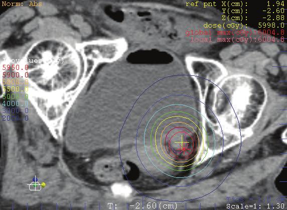 2 Case Reports in Urology Figure1:SBRTplanisodoselineofcase1. LINAC. A total dose of 60 Gy was delivered in 10 fractions at the center of PTV using 10 MV photons.