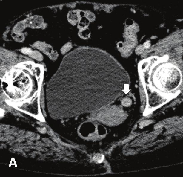 Case Reports in Urology 3 (a) (b) Figure 3: Contrast-enhanced CT scan of the patient.