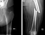 before and during treatment Atypical Femoral fractures Association with