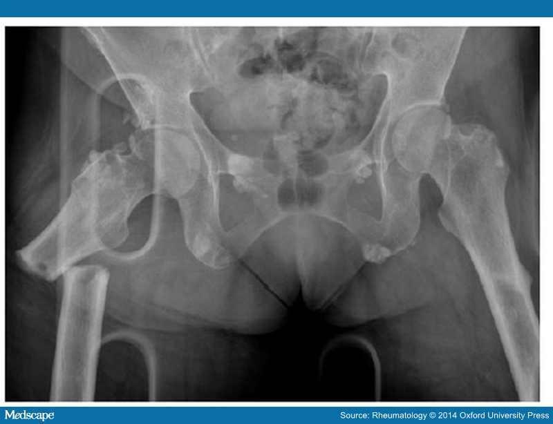 Management of atypical femoral fractures Stop bisphosphonate Request urgent xray of whole femur Periosteal